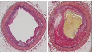 冠状動脈硬化の血管比較画像