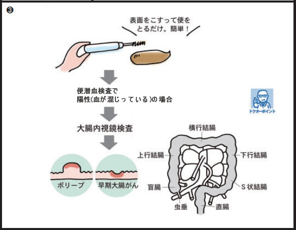 大腸がん検診