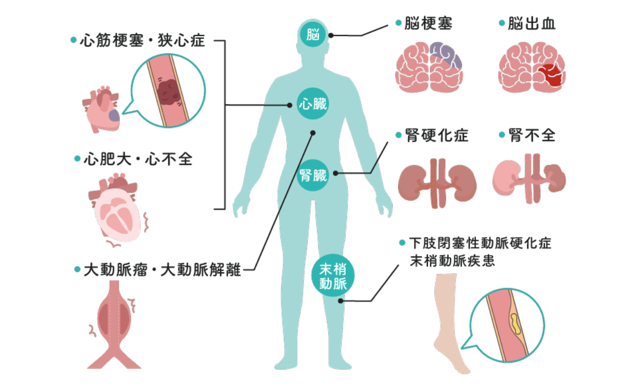 高血圧症から起きる可能性がある病気