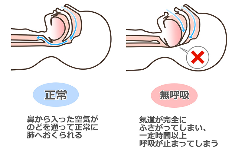 閉塞性睡眠時無呼吸