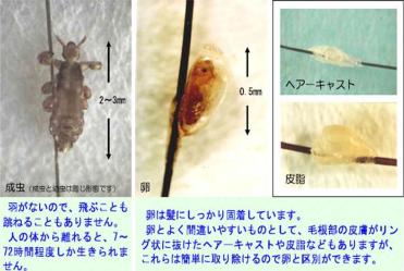 アタマジラミの成虫と卵、ヘアーキャストと皮脂