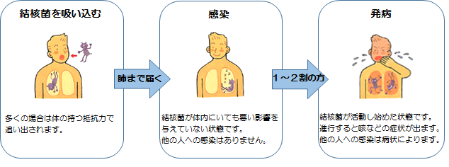 イラスト　発病まで、結核菌を吸い込み肺まで届くと、肺まで届き感染する。その後1、2割の人が発病する。